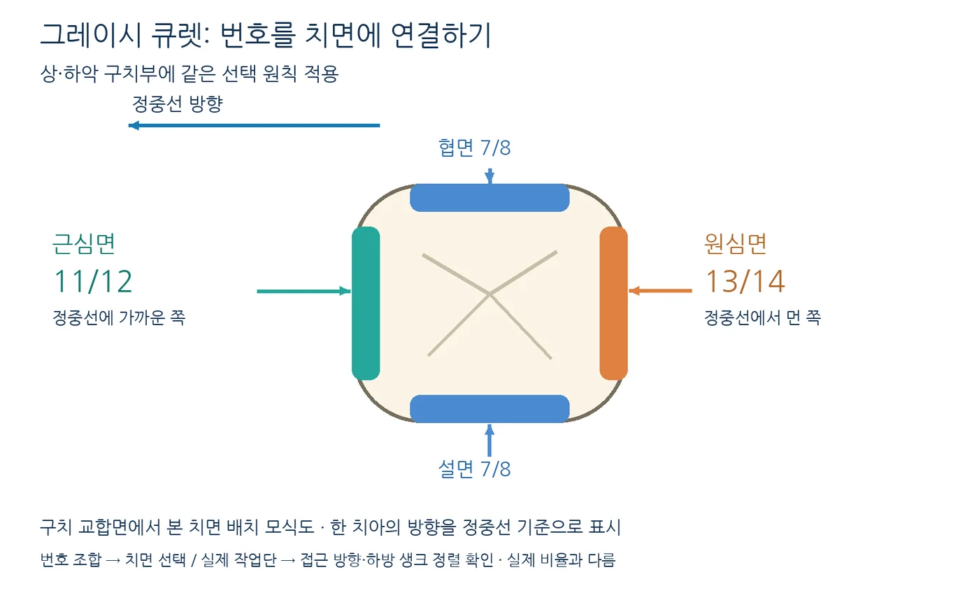 그레이시 큐렛의 구치부 적용 치면