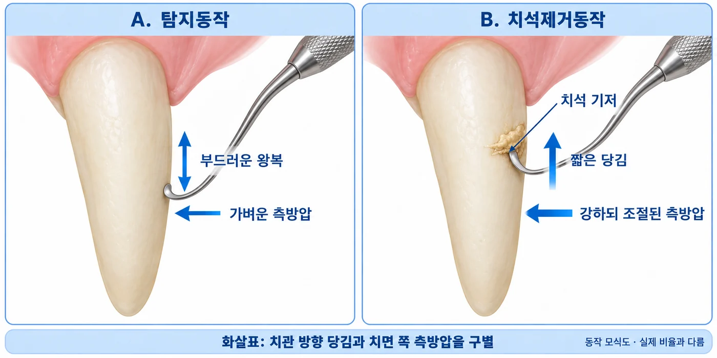 탐지·제거 스트로크와 측방압