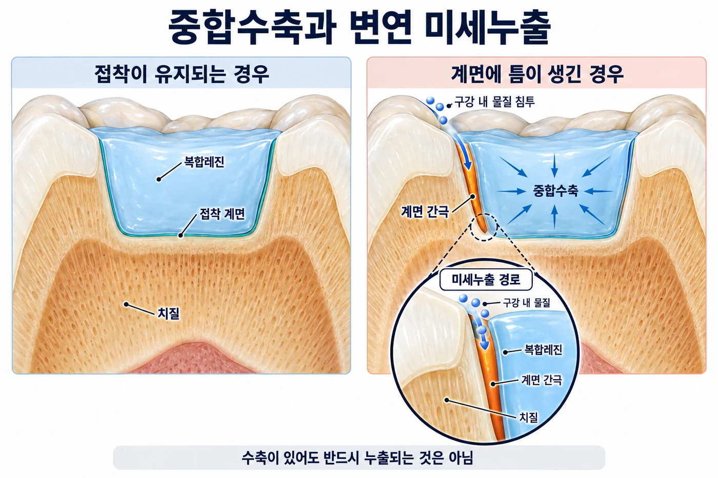 중합수축과 변연 미세누출