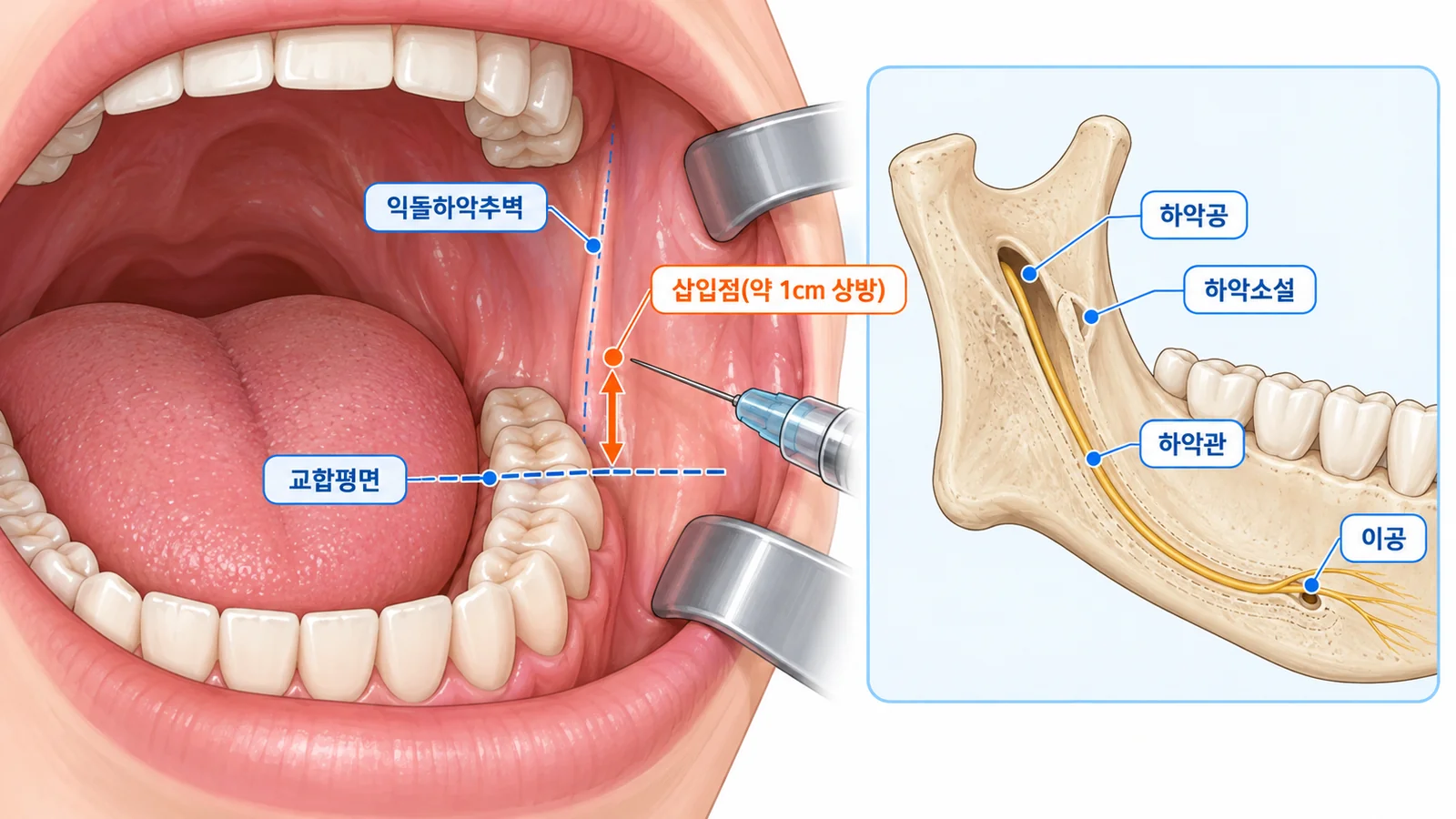 하악 전달마취의 삽입점과 해부
