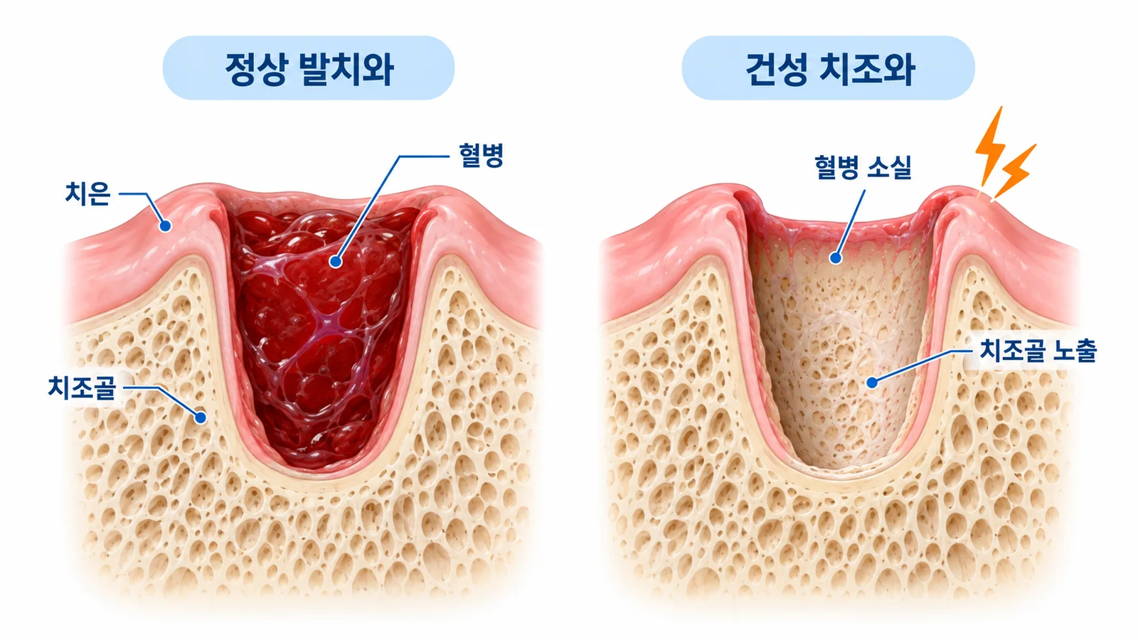 정상 발치와와 건성 치조와
