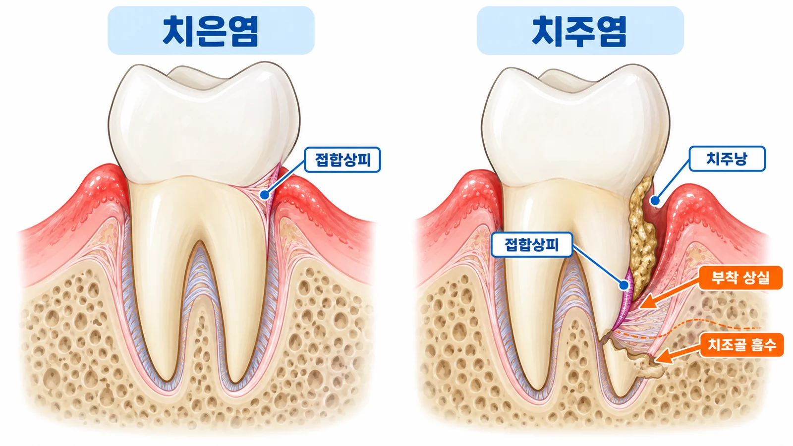 치은염과 치주염의 비교
