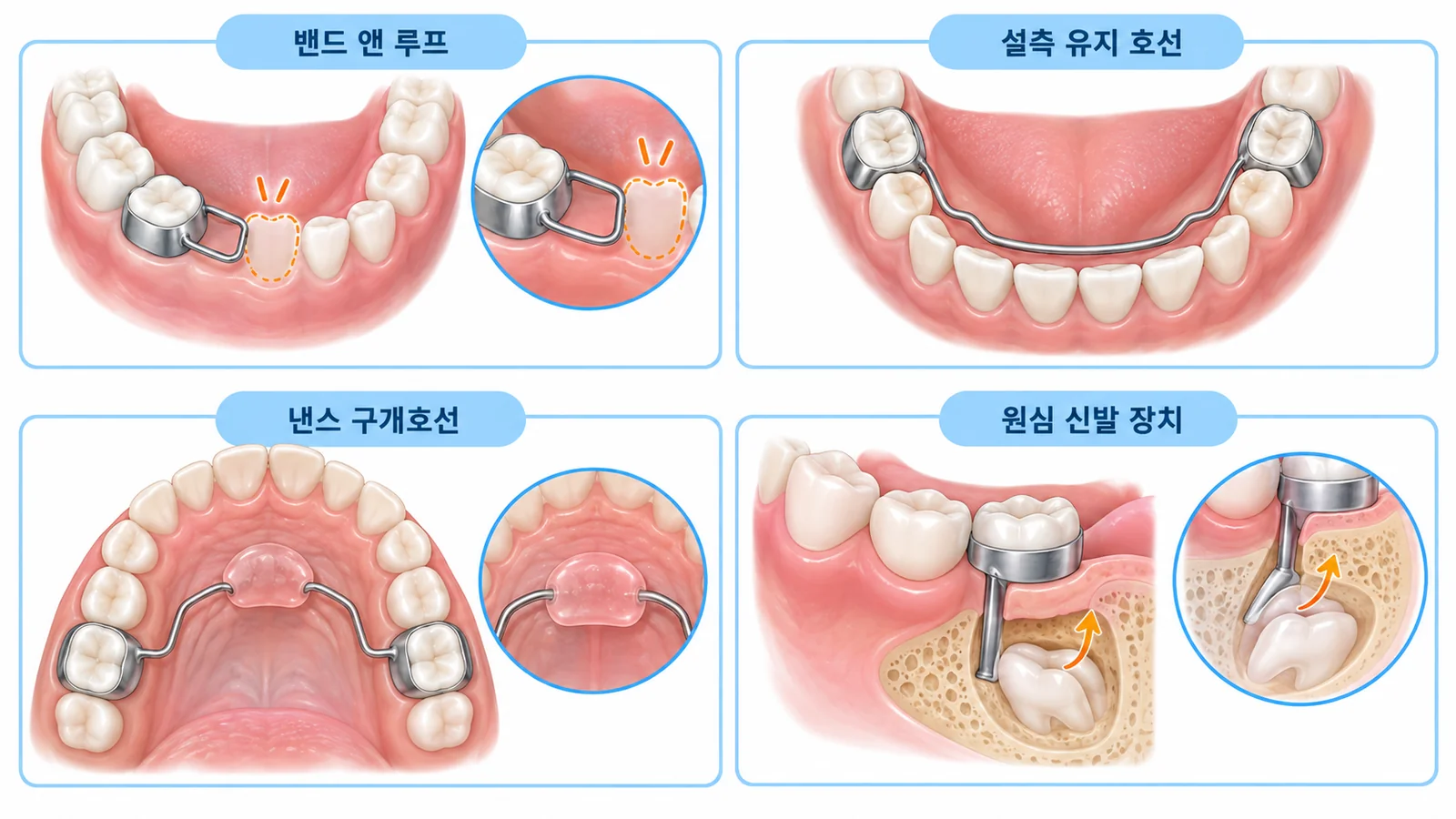 공간유지장치 4종