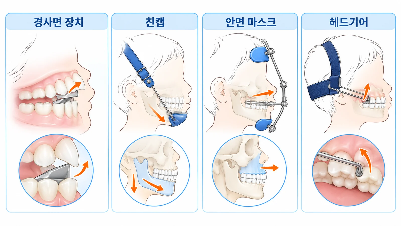 성장기 교정 장치 4종