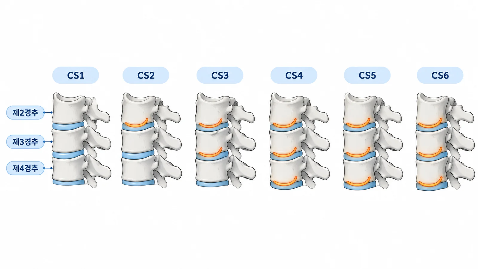 경추골 성숙도 CS1~CS6