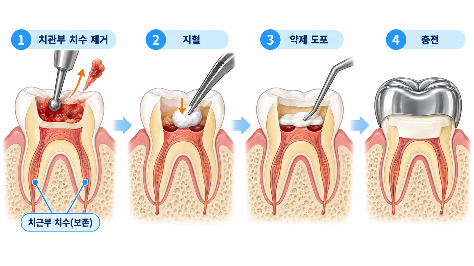 생활치수절단술