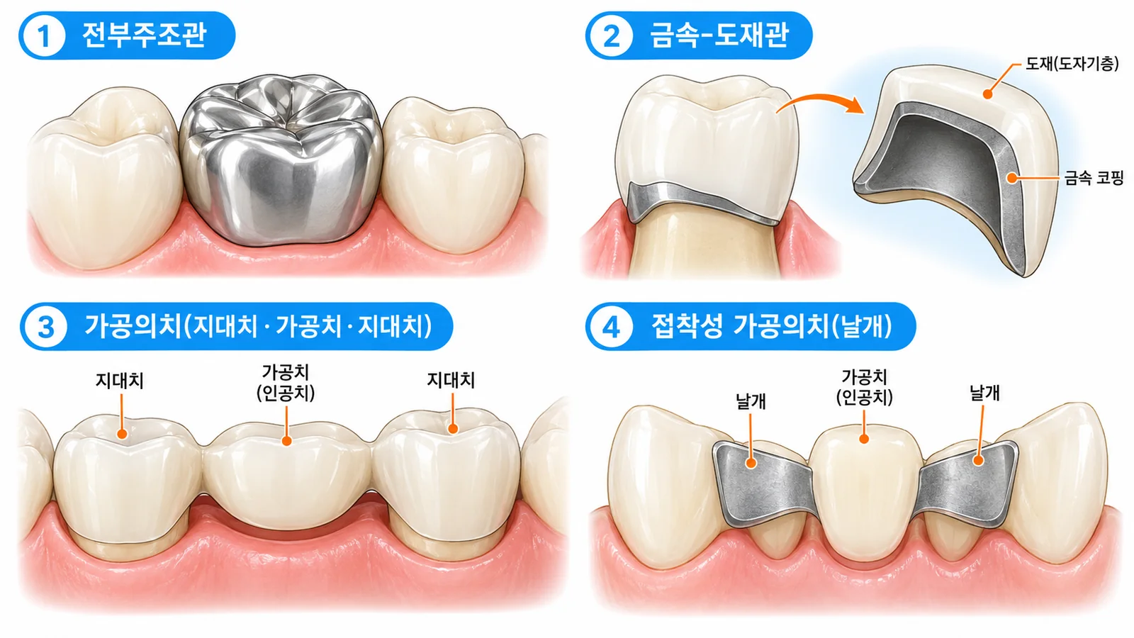 고정성 보철물의 종류