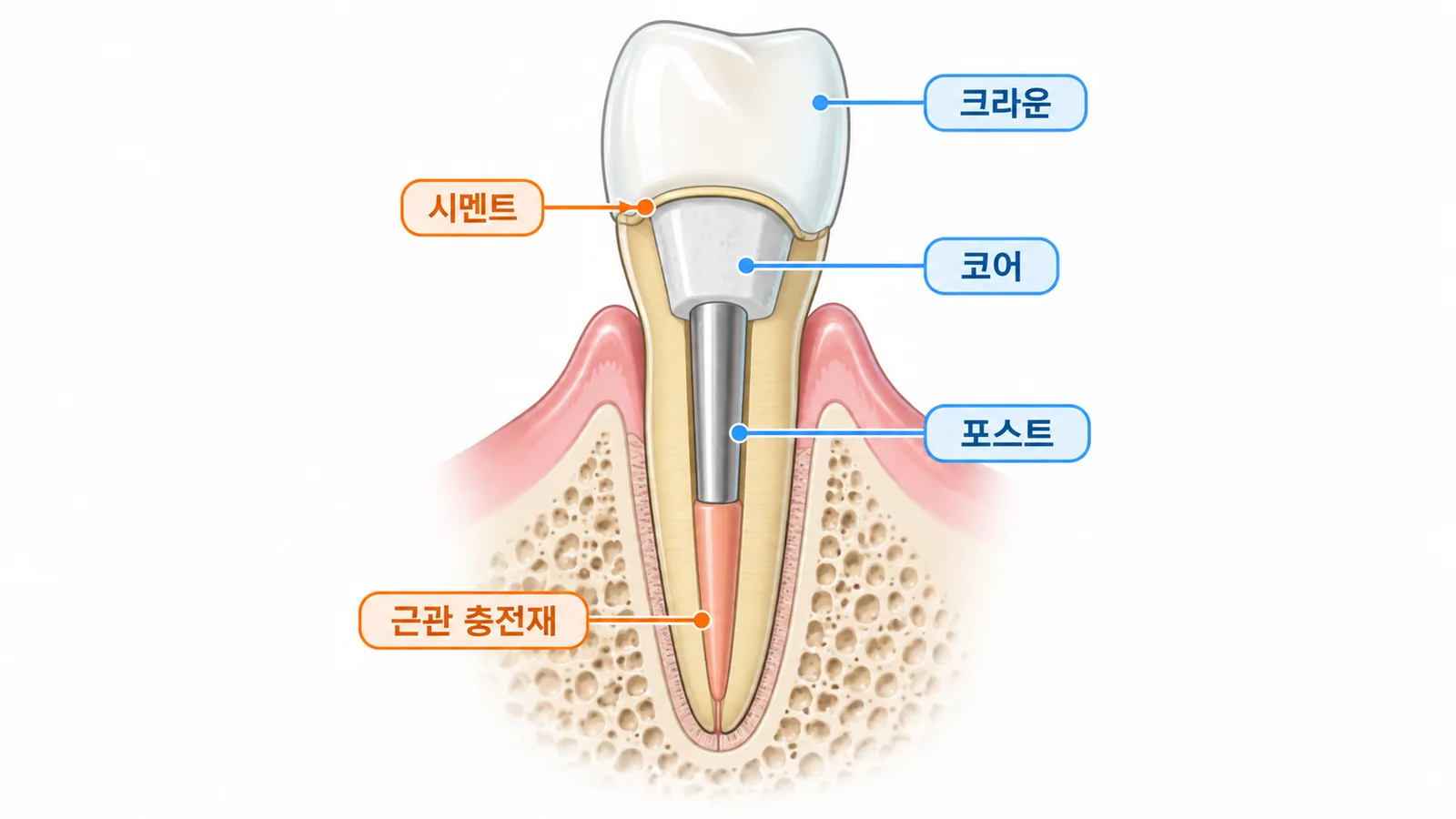 포스트·코어·크라운