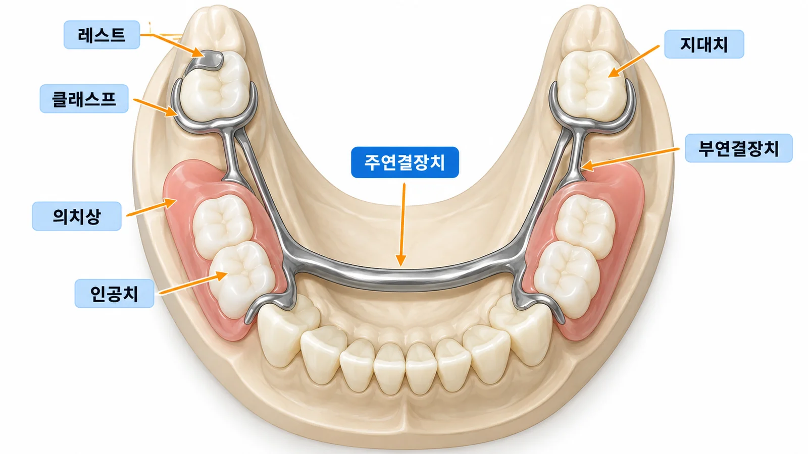 국소의치의 구성