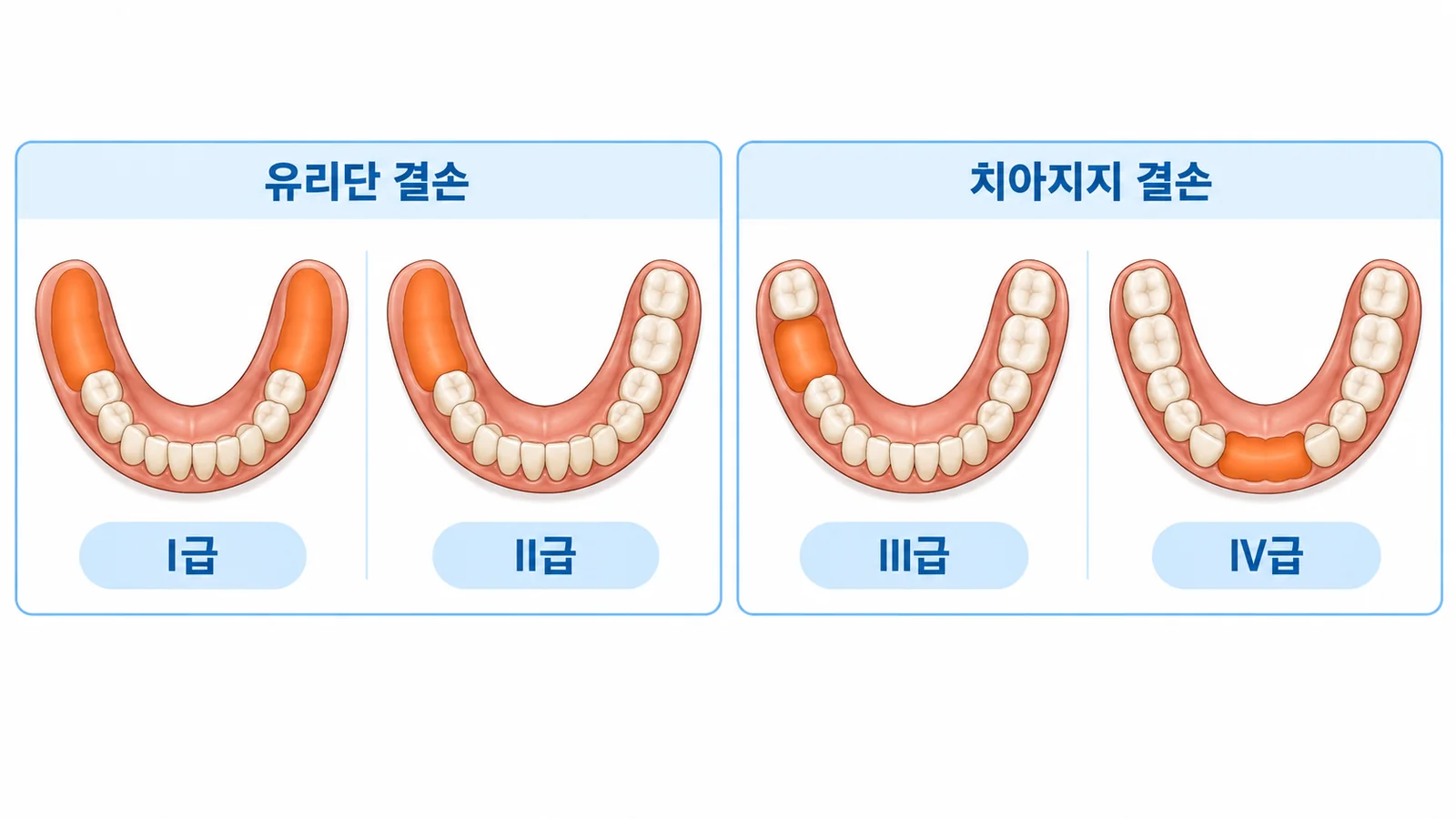 케네디 분류 I~IV급