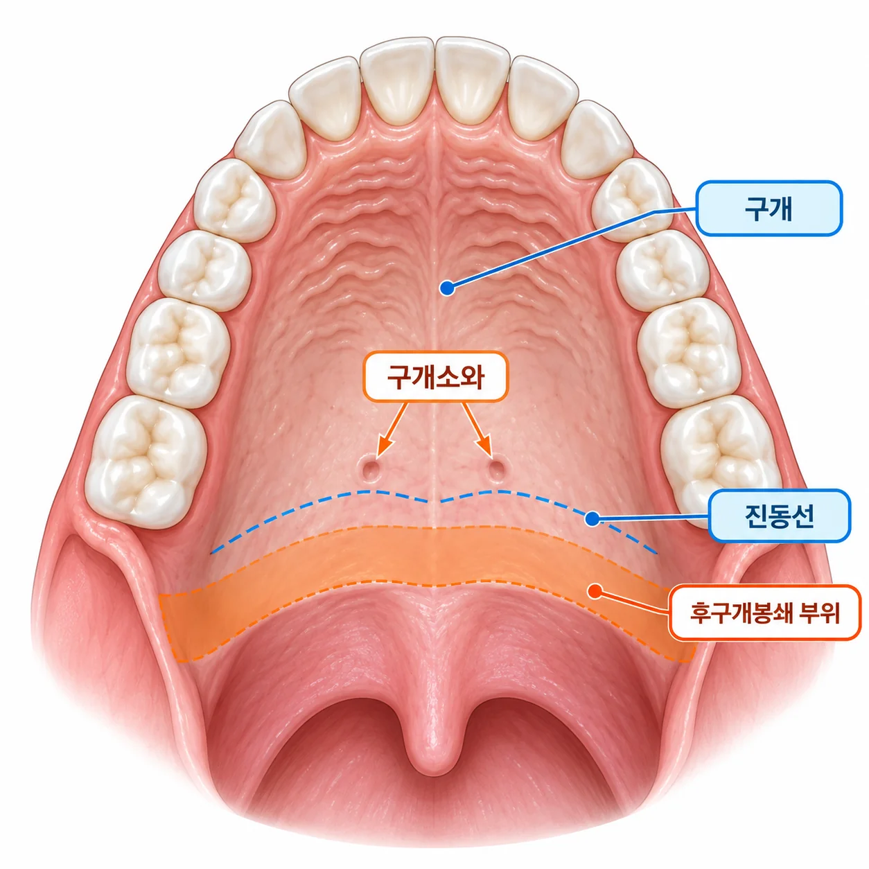상악 총의치 후방 경계
