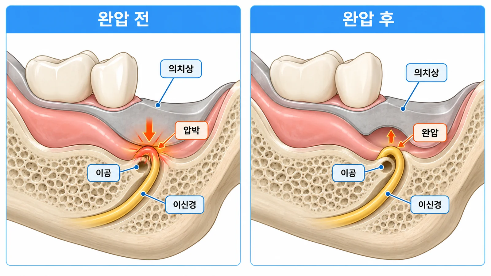 치조제 흡수와 이공