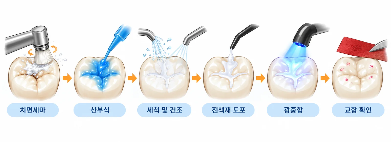 치면열구전색 6단계