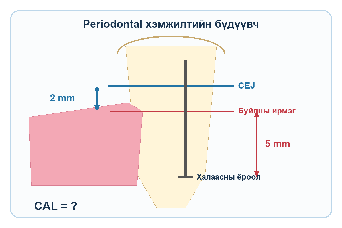 CEJ-ээс буйлны ирмэг хүртэл 2 миллиметр recession, probing depth 5 миллиметрийг харуулсан periodontal бүдүүвч