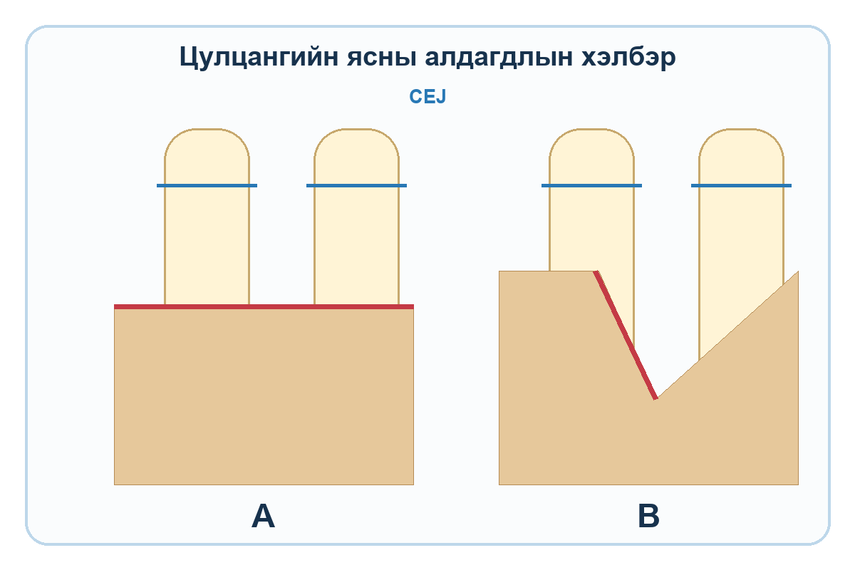 A самбарт хэвтээ, B самбарт өнцөгт босоо цулцангийн ясны алдагдлыг харуулсан бүдүүвч