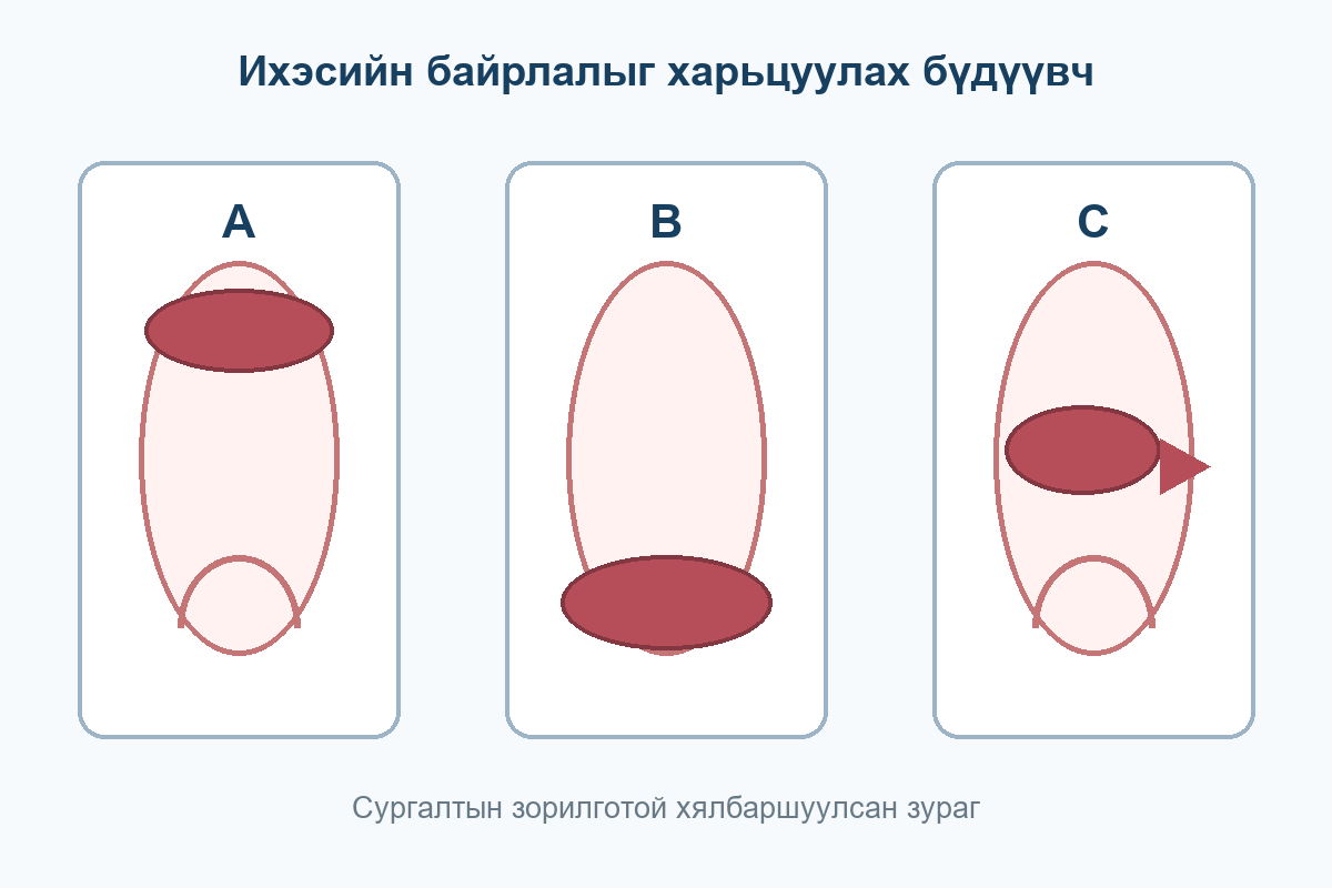 A ихэс умайн дээд хэсэгт, B умайн хүзүүний амсрыг бүрхсэн, C хажуу хананаас хэсэгчлэн салсан байршлын бүдүүвч