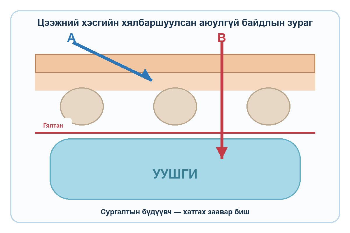 Арьс, хавирга, гялтан, уушгины хялбаршуулсан огтлол дээр A ташуу, B гүн босоо чиглэлийг харуулсан аюулгүй байдлын зураг